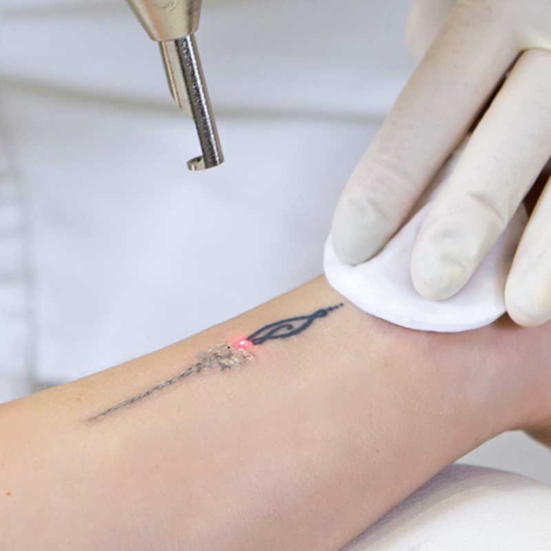 Silhouet-Tone YAG Laser Tattoo Removal System